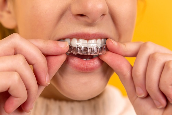 How Clear Aligners Straighten Teeth Without The Hassle Of Braces