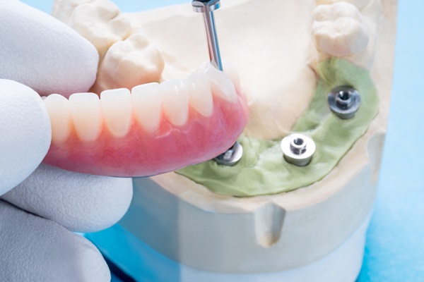 Implant Overdentures: A Secure And Comfortable Alternative To Traditional Dentures
