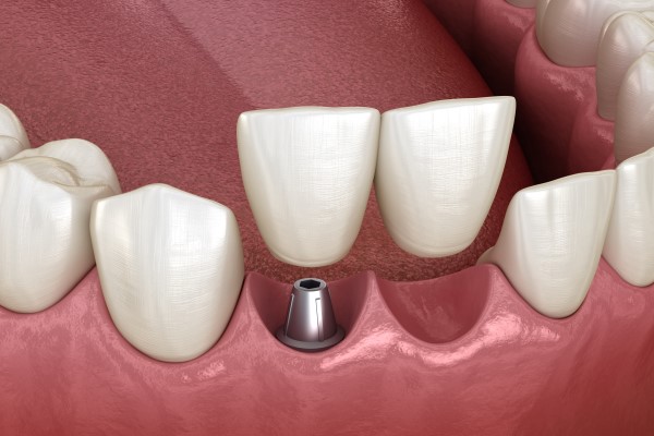 The Real Cost Of Delaying Tooth Replacement